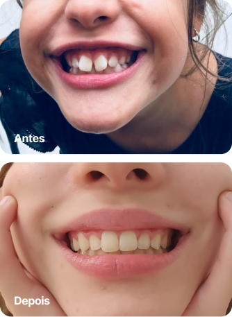 Dr. Roque Queiroz - Ortodontia Especializada em Pinheiro | Imagem de Antes e Depois do Tratamento