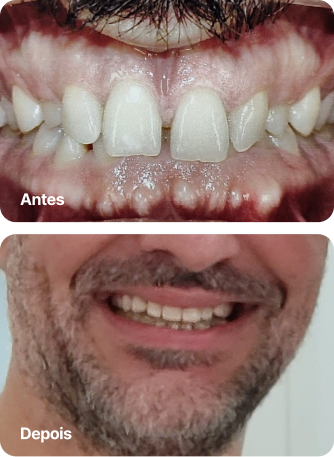 Dr. Roque Queiroz - Ortodontia Especializada em Pinheiro | Imagem de Antes e Depois do Tratamento