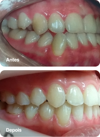 Dr. Roque Queiroz - Ortodontia Especializada em Pinheiro | Imagem de Antes e Depois do Tratamento