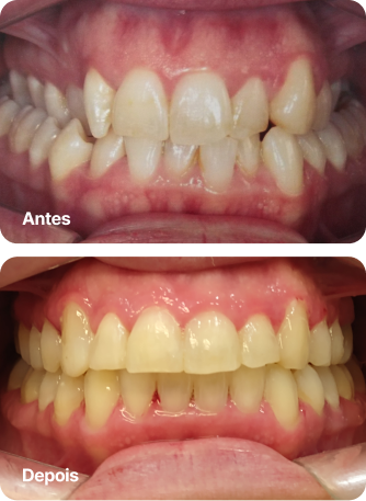 Dr. Roque Queiroz - Ortodontia Especializada em Pinheiro | Imagem de Antes e Depois do Tratamento