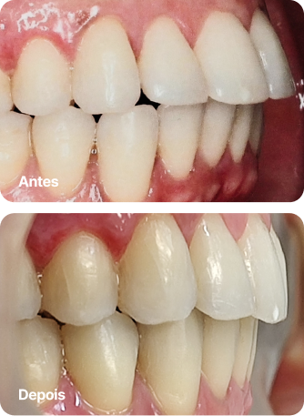 Dr. Roque Queiroz - Ortodontia Especializada em Pinheiro | Imagem de Antes e Depois do Tratamento