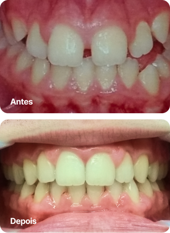 Dr. Roque Queiroz - Ortodontia Especializada em Pinheiro | Imagem de Antes e Depois do Tratamento